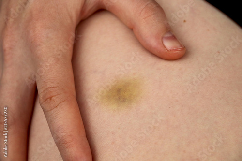 Bright bruise damage on leg of young woman. A girl rubs her fingers with a curative ointment in a bruised knee with a bruise. Pain concept close-up.hematoma on the leg.bruise on the leg