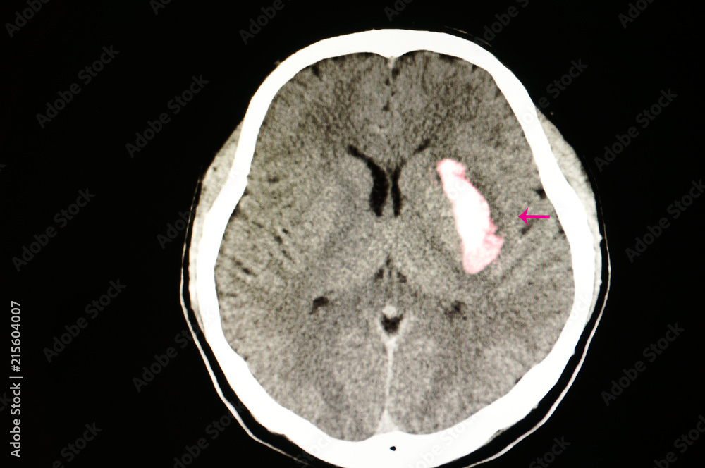 CT scan of the brain of a stroke patient with large blood clot or
