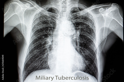 miliary pulmonary tuberculosis photo