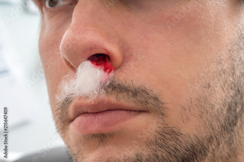 Quadro su tela Young man with bleeding nose has cotton wool in nostril.