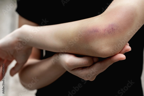 A teenager girl show a big purple bruise on her left arm that is caused by her accidentally fall off from the stairs.