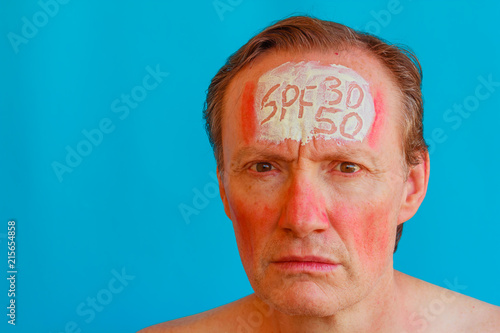 a man has a solar erythema because he did not put 30 or 50 high sunscreen /the sunscreen must be put before exposing yourself to the sun to avoid erythema