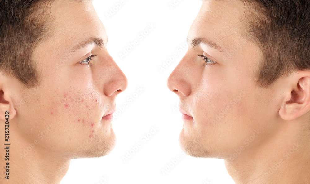 Young man with acne problem on white background Young man with acne problem on white background