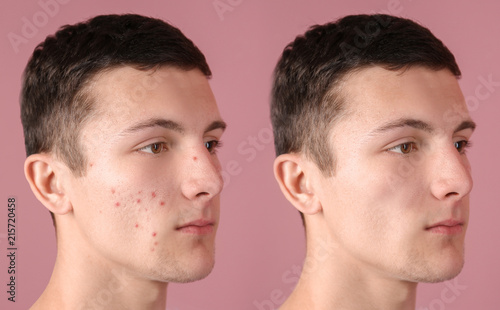 Fototapeta Naklejka Na Ścianę i Meble -  Young man with acne problem on color background