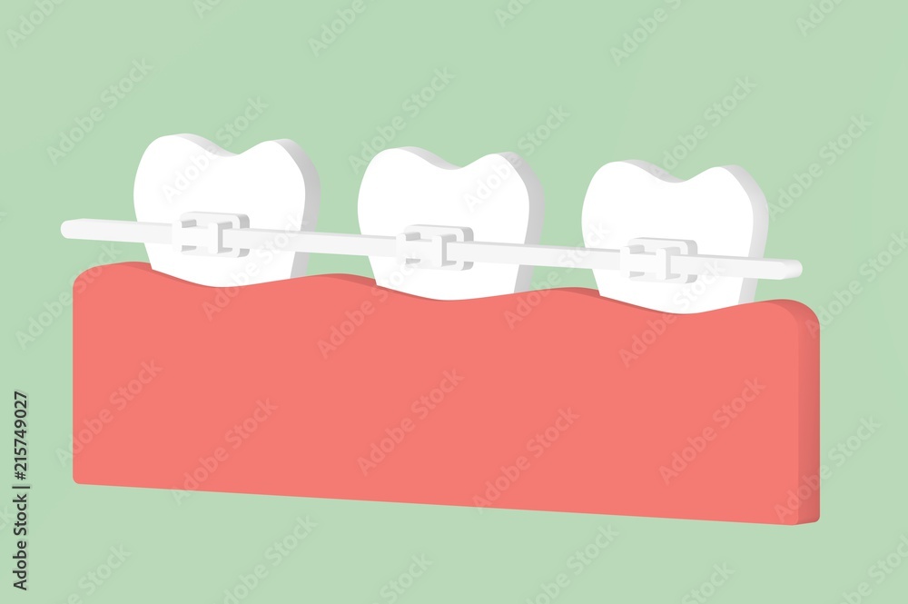 orthodontic teeth or dental braces - tooth cartoon 3d render Stock ...