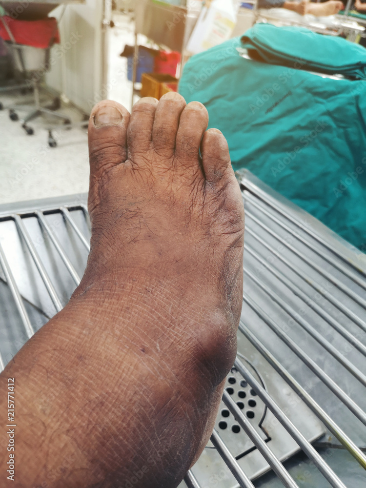 Gout Foot Deformity at Lashay Carlson blog