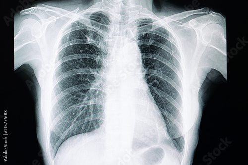 pulmonary tuberculosis