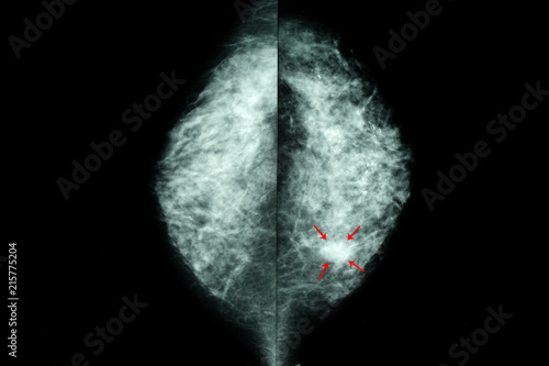 mammogram of  female breasts