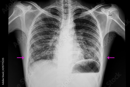 bilateral lower lungs pneumonia