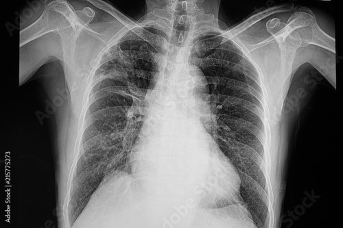 pulmonary tuberculosis photo