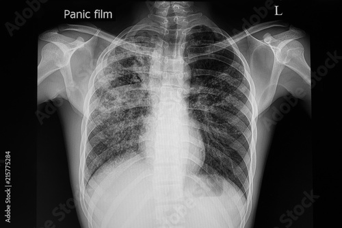 Pulmonary tuberculosis photo