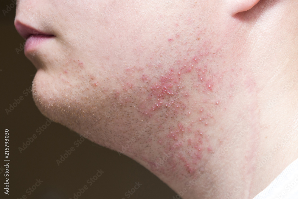 Irritation after shaving on the neck of a man, close-up Irritation after shaving on the neck of a man, close-up