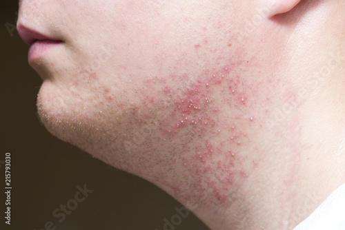Irritation after shaving on the neck of a man, close-up