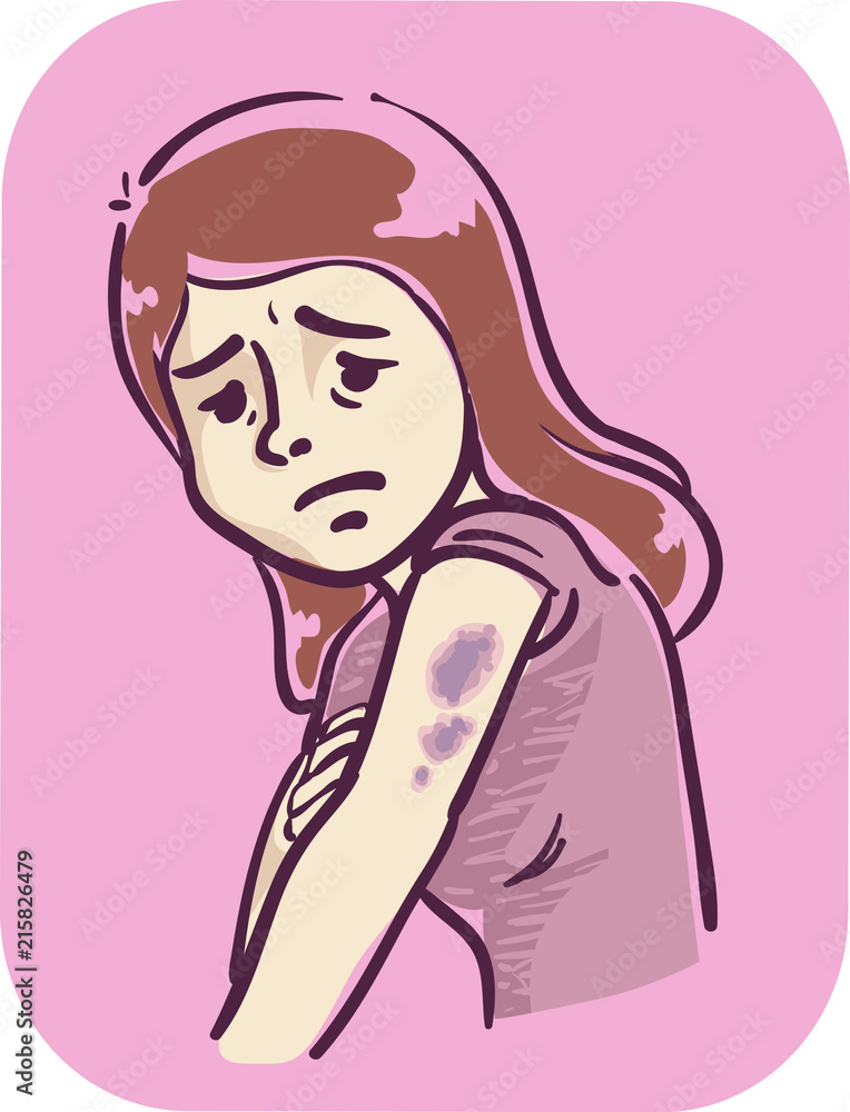Girl Symptom Contusion Bruise Illustration Girl Symptom Contusion Bruise Illustration
