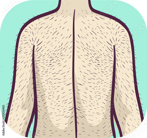 Symptoms Hairy Back Hypertrichosis Illustration