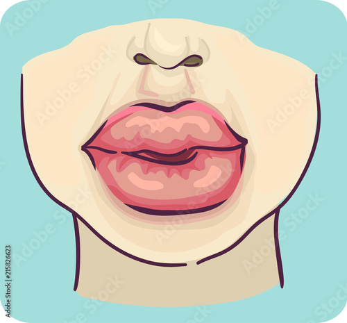 Symptoms Swelling Lips Illustration