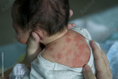 Close-up common rash in newborn usually between 2-5 day after birth. (Erythema Toxicum)
