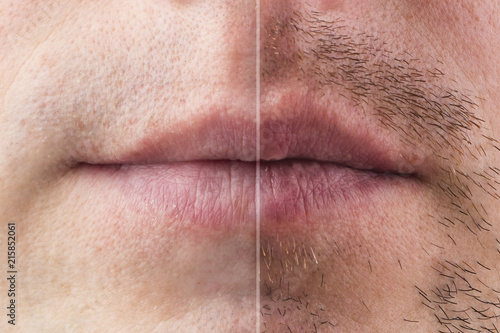 Billede på lærred The result on the mans face after shaving, before and after