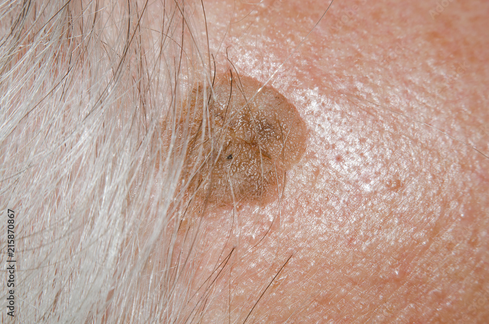 Fototapeta premium Birthmark of a teratoma on the skin of an old man's head close-up