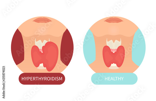 Woman with healthy thyroid gland and hyperthyroidism made in cartoon style. Front view sign. Human body organ anatomy icon. Medical concept. Vector illustration made in cartoon style.