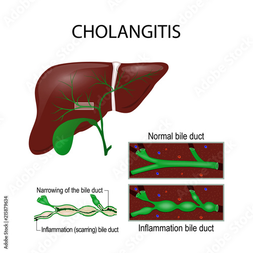 Cholangitis. Cross section of the human liver, bile duct, and gallbladder.