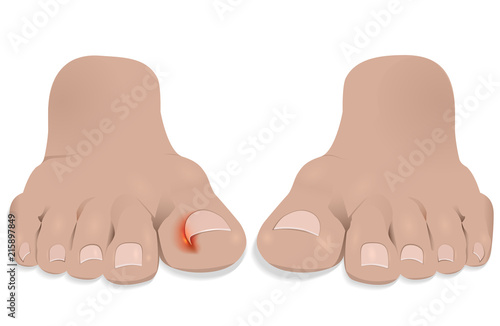 Nail disease. Ingrown nail. Onychocryptosis. 