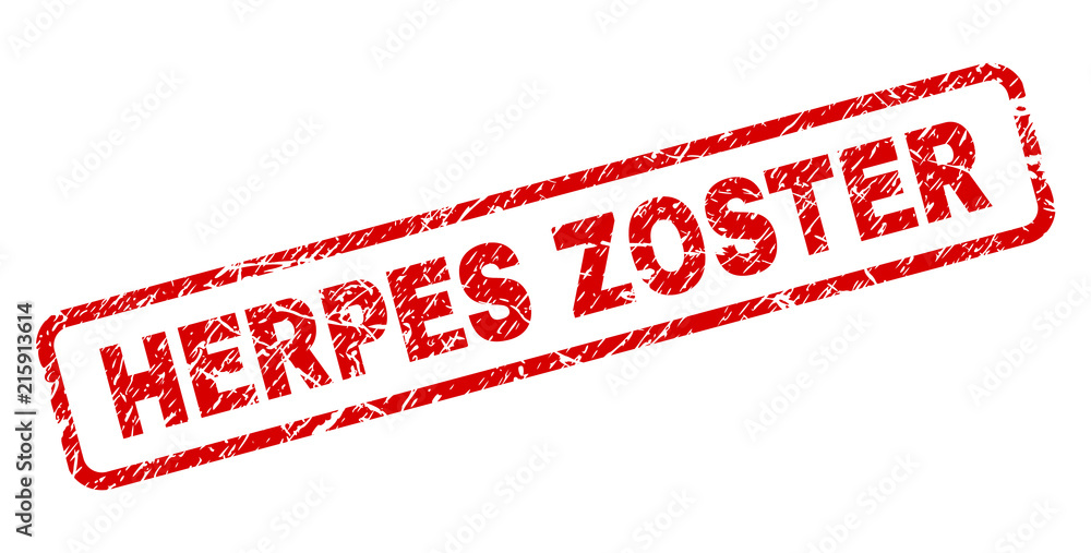 HERPES ZOSTER stamp seal print with scratced style. Red vector rubber print of HERPES ZOSTER tag with corroded texture. Text tag is placed inside rounded rectangle frame. HERPES ZOSTER stamp seal print with scratced style. Red vector rubber print of HERPES ZOSTER tag with corroded texture. Text tag is placed inside rounded rectangle frame.