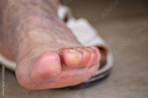 foot finger whitlow
