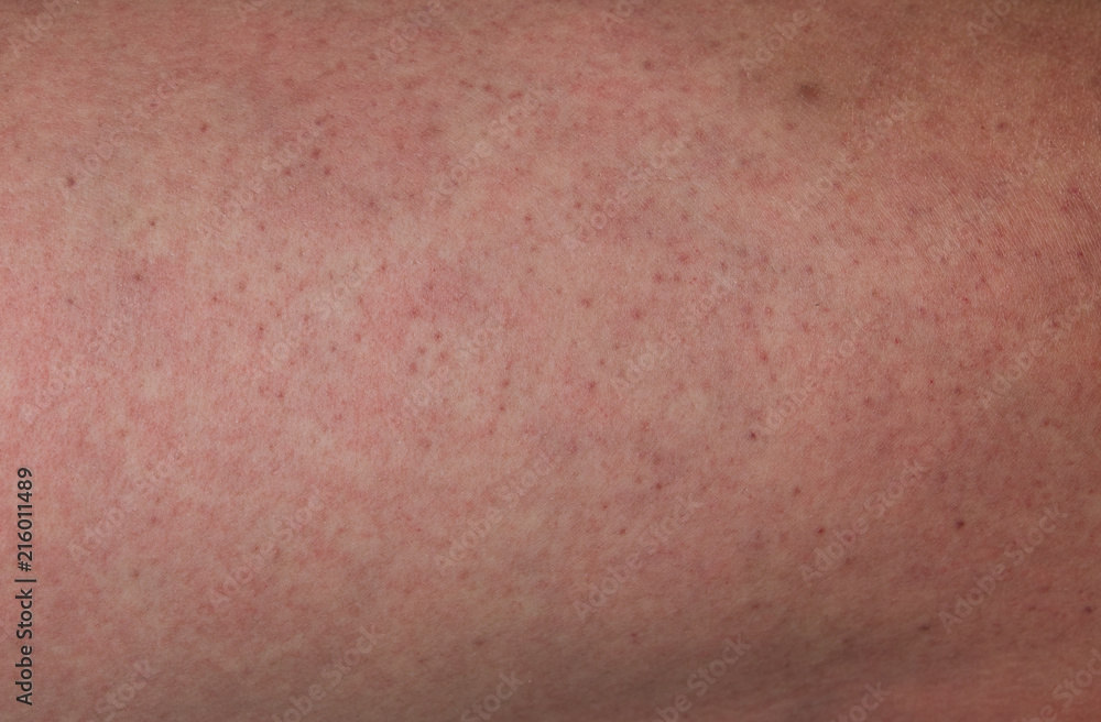 Close up human skin with red rashes from dengue disease Close up human skin with red rashes from dengue disease