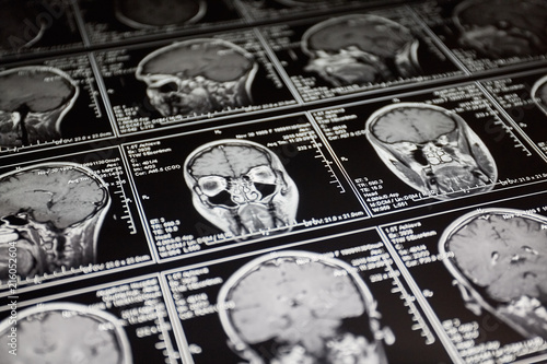 Magnetic resonance scan of the brain. MRI head scan