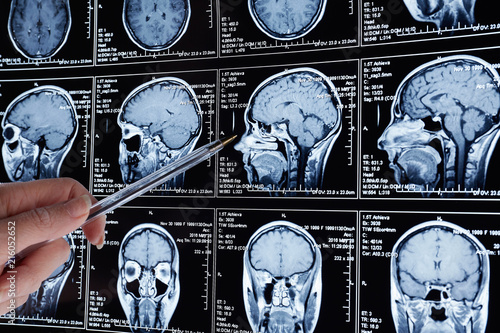 Magnetic resonance scan of the brain. MRI head scan