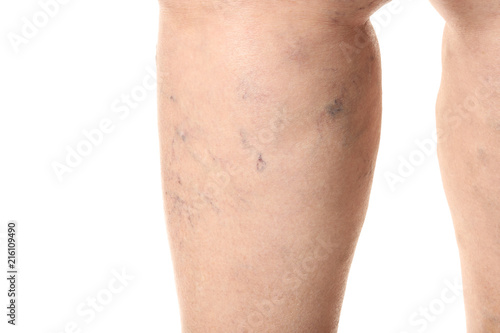 Woman's leg with varicose on white background, closeup