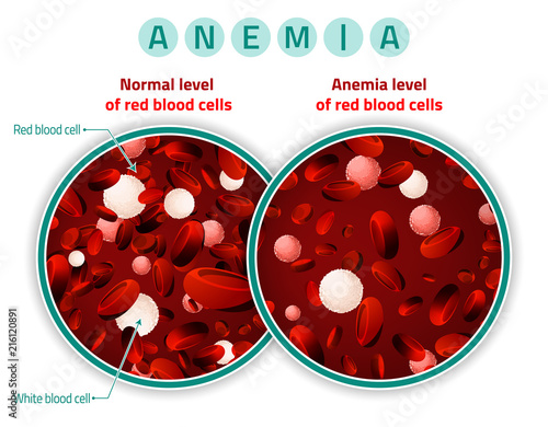 Anemia level of blood cells