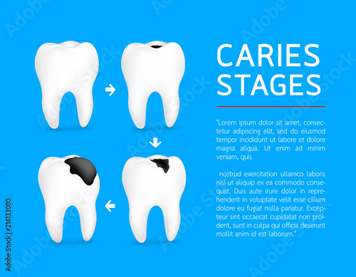 Tooth on different stages of dental caries development. Enamel caries, Dentin caries, Pulpitis and Periodontitis. Design for banner and poster. Illustration on blue background.
