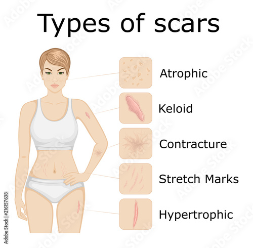 Canvas Print Types of scars