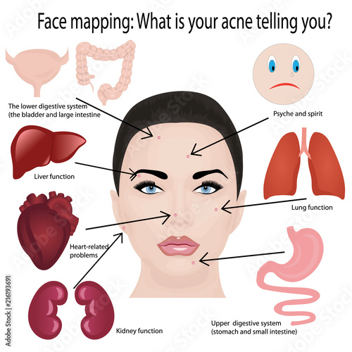 Face mapping. What your acne telling you info-graphic