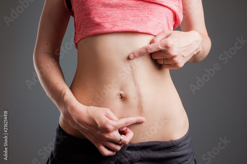Fototapeta Woman with long abdominal scars after operation