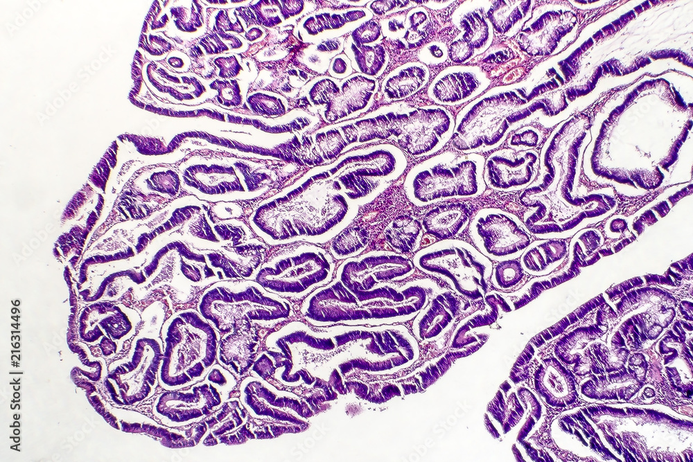 Intestinal polypoid adenoma, light micrograph, photo under microscope ...