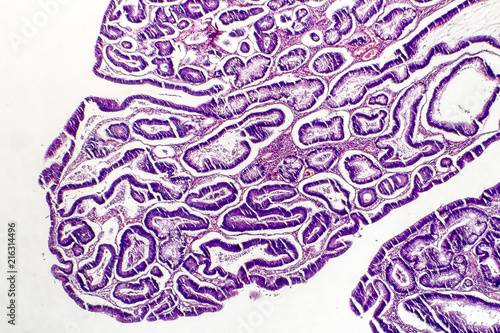 Intestinal polypoid adenoma, light micrograph, photo under microscope photo