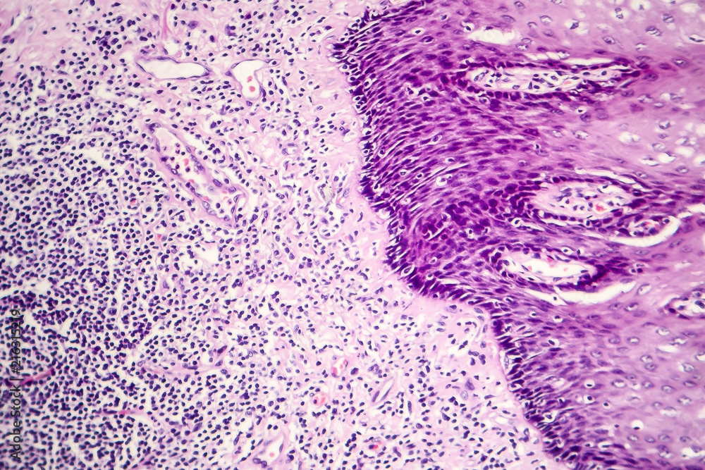 Squamous Cell Microscope Squamous cell carcinoma, light micrograph, photo under microscope Stock ...