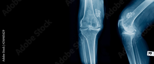 Foto x-ray OA knee with structure like calcium