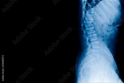 x-ray lumabar spondylosis with T12-L1 spondylolisthesis photo