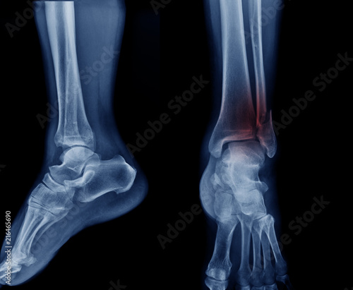 Photo x-ray image tibia fracture
