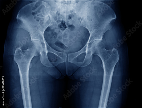 Obraz na płótnie hip and pelvic bone x-ray