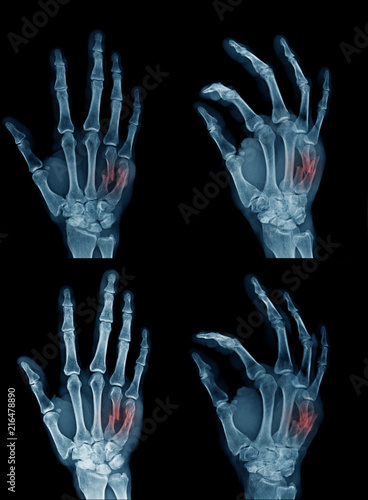 coleection hand x-ray photo