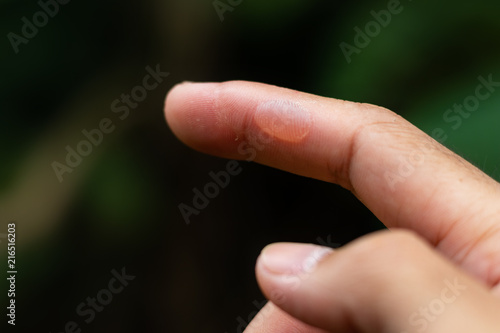 Blisters on finger caused. Injured against. Fototapeta