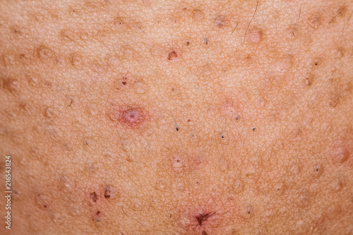 Skin lesions on the skin. photo