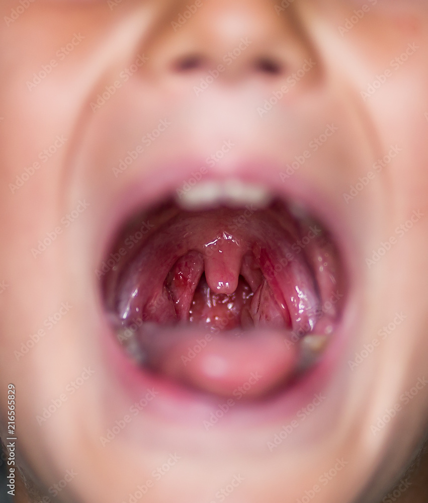 Fototapeta premium Chronic tonsillitis. Herpes