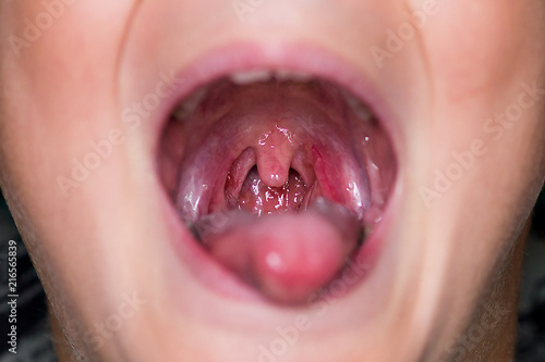 Chronic tonsillitis. Herpes photo