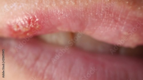 ulcers from herpes on female lips macro. Colds on the lips.